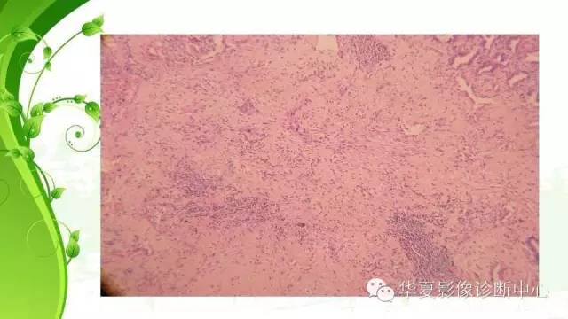 【PPT】早期肺腺癌中塌陷的病理影像分析