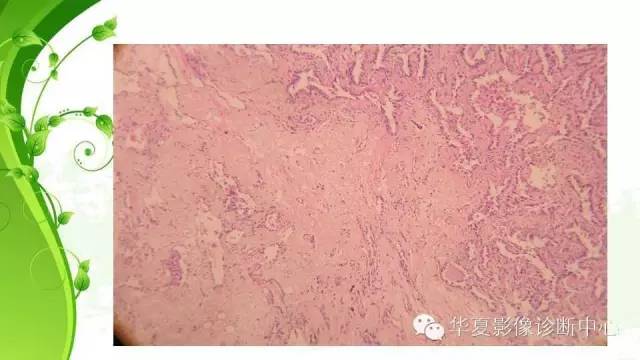 【PPT】早期肺腺癌中塌陷的病理影像分析