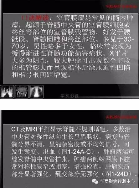 脊髓室管膜瘤的经典总结