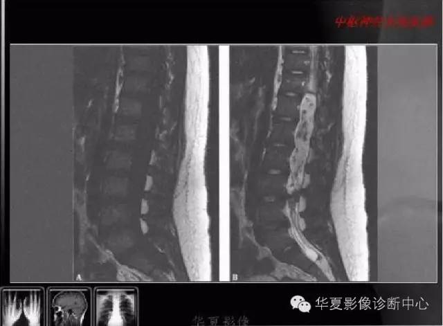 脊髓室管膜瘤的经典总结