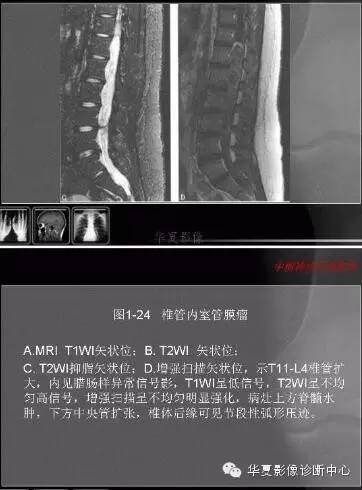 脊髓室管膜瘤的经典总结