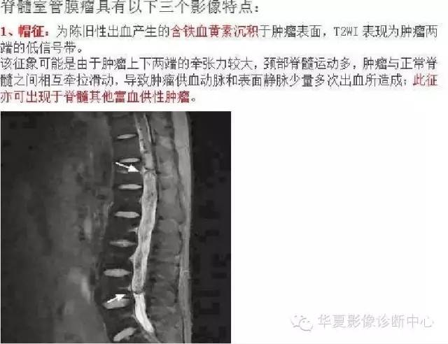 脊髓室管膜瘤的经典总结