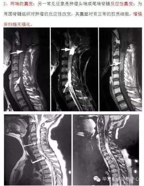 脊髓室管膜瘤的经典总结