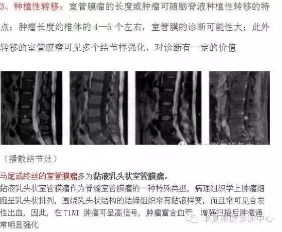 脊髓室管膜瘤的经典总结