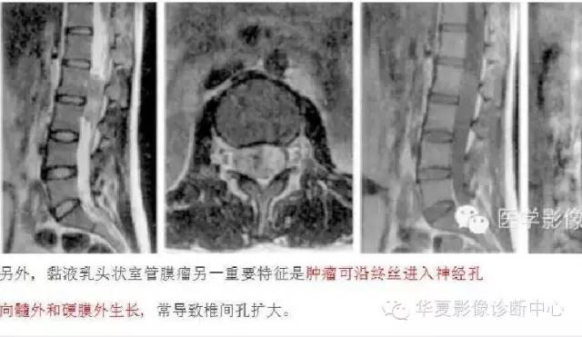 脊髓室管膜瘤的经典总结