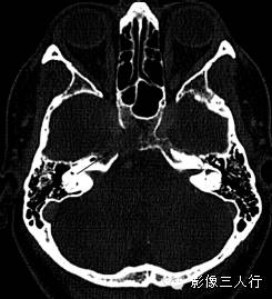 4种斜坡区肿瘤的CT鉴别 4种斜坡区肿瘤的CT鉴别