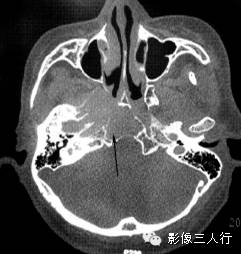 4种斜坡区肿瘤的CT鉴别 4种斜坡区肿瘤的CT鉴别