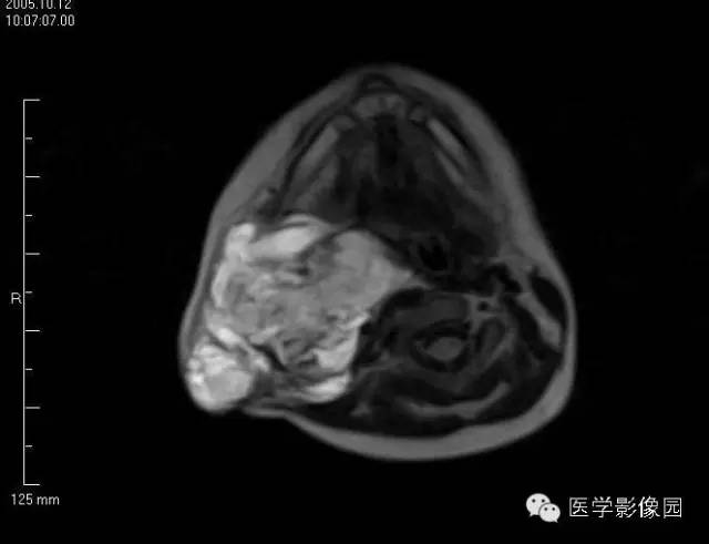 【病例】颈部淋巴管瘤1例MR影像表现