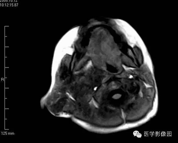【病例】颈部淋巴管瘤1例MR影像表现