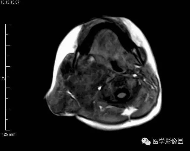 【病例】颈部淋巴管瘤1例MR影像表现