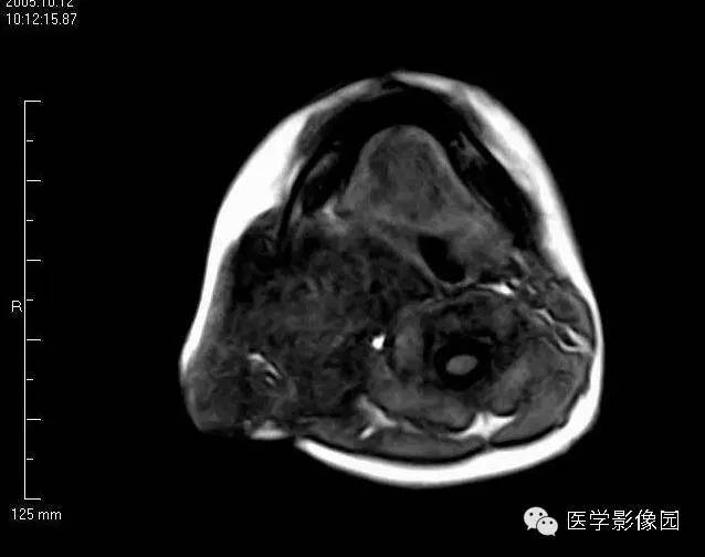 【病例】颈部淋巴管瘤1例MR影像表现