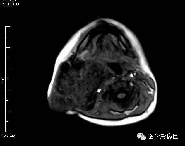 【病例】颈部淋巴管瘤1例MR影像表现