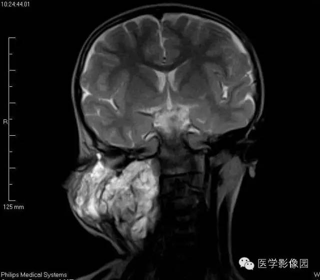 【病例】颈部淋巴管瘤1例MR影像表现