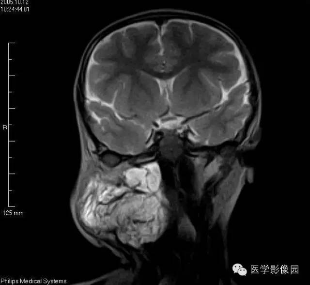 【病例】颈部淋巴管瘤1例MR影像表现
