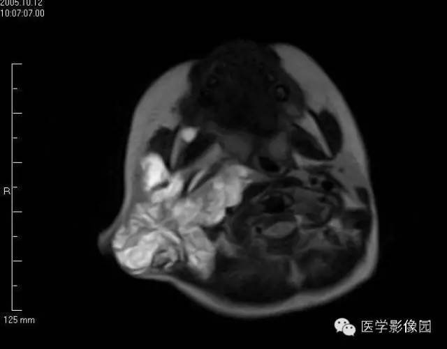【病例】颈部淋巴管瘤1例MR影像表现