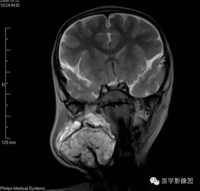 【病例】颈部淋巴管瘤1例MR影像表现