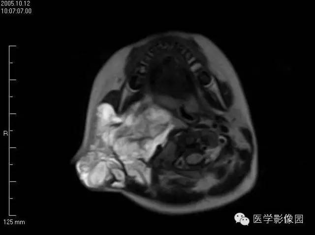 【病例】颈部淋巴管瘤1例MR影像表现