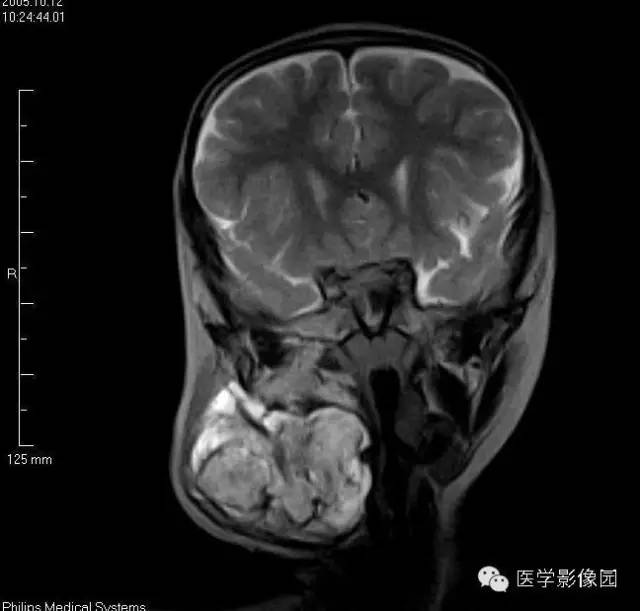 【病例】颈部淋巴管瘤1例MR影像表现