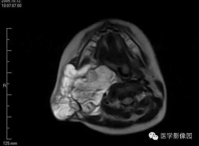 【病例】颈部淋巴管瘤1例MR影像表现