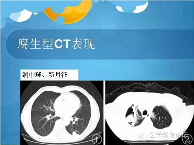 【PPT】肺曲霉菌病CT表现
