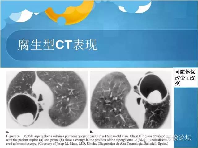 【PPT】肺曲霉菌病CT表现