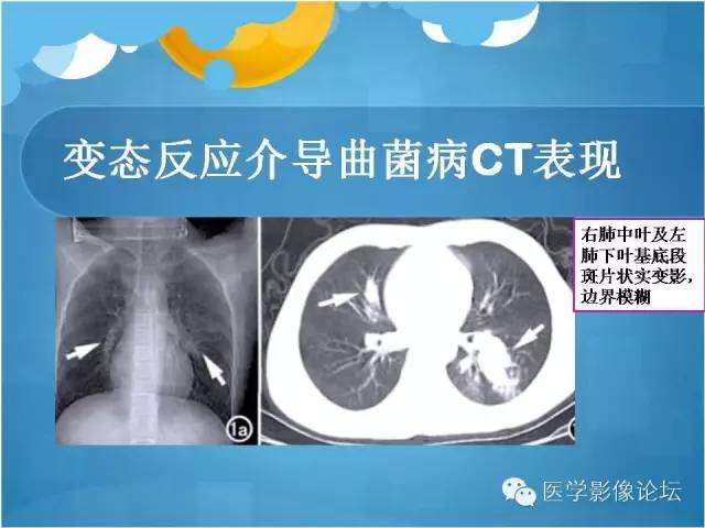 【PPT】肺曲霉菌病CT表现