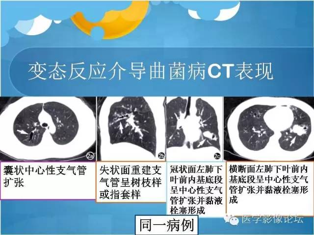 【PPT】肺曲霉菌病CT表现