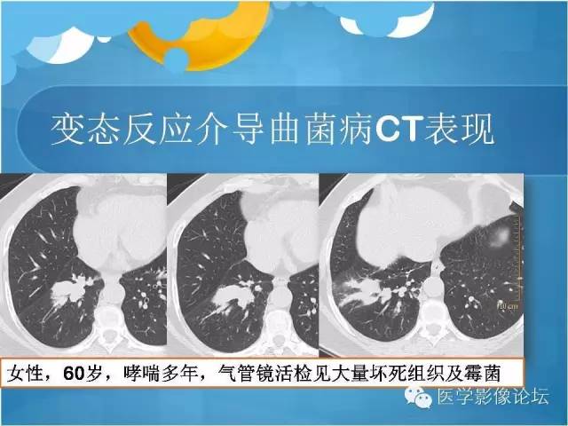 【PPT】肺曲霉菌病CT表现