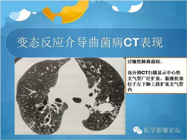 【PPT】肺曲霉菌病CT表现