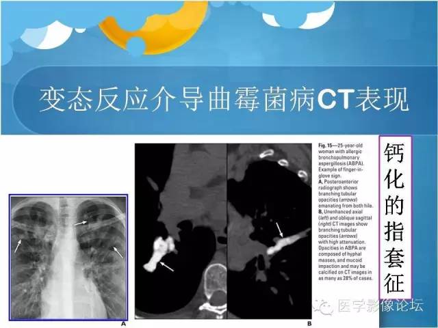 【PPT】肺曲霉菌病CT表现