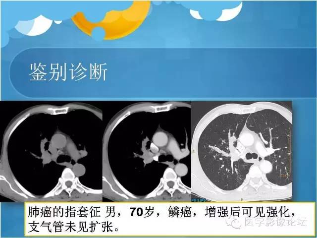 【PPT】肺曲霉菌病CT表现