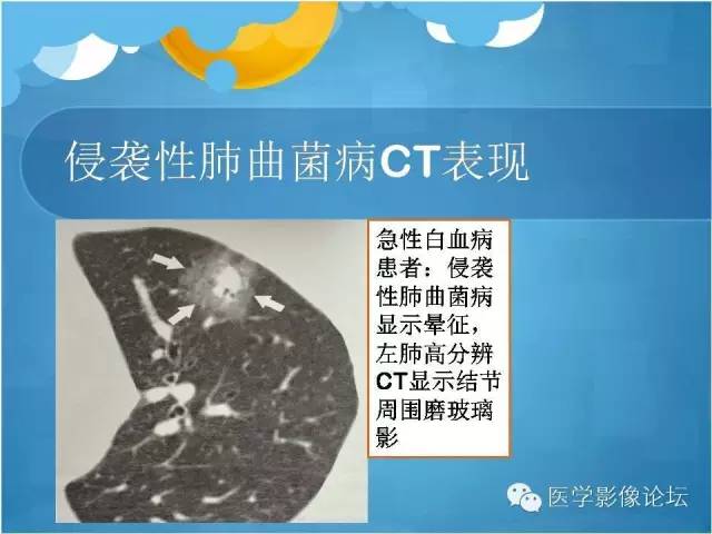 【PPT】肺曲霉菌病CT表现