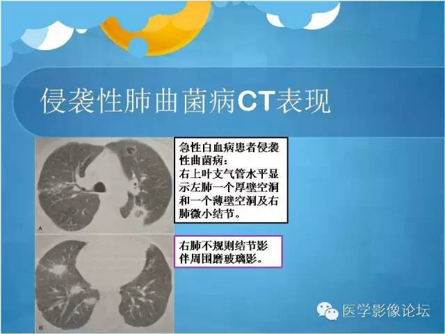 【PPT】肺曲霉菌病CT表现