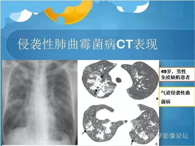 【PPT】肺曲霉菌病CT表现