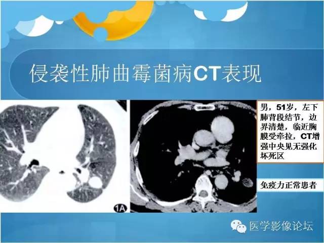 【PPT】肺曲霉菌病CT表现