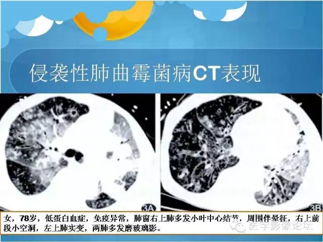 【PPT】肺曲霉菌病CT表现