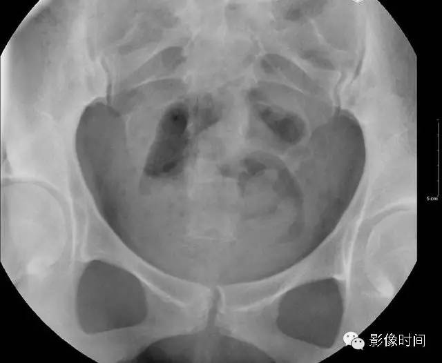 【病例】双子宫畸形1例影像表现