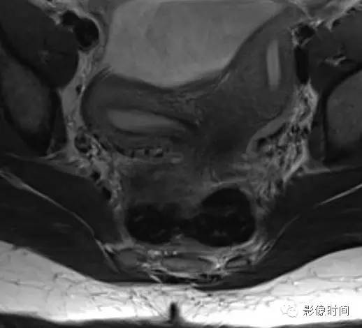 【病例】双子宫畸形1例影像表现 【病例】双子宫畸形1例影像表现
