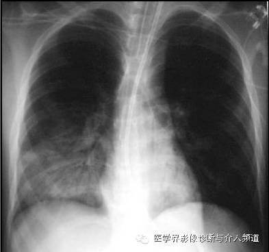一张胸片走江湖之大叶性肺炎