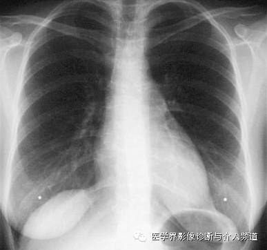 一张胸片走江湖之大叶性肺炎 一张胸片走江湖之大叶性肺炎