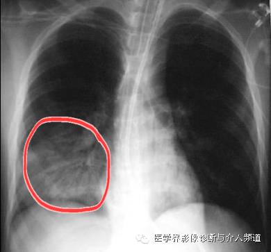 一张胸片走江湖之大叶性肺炎 一张胸片走江湖之大叶性肺炎