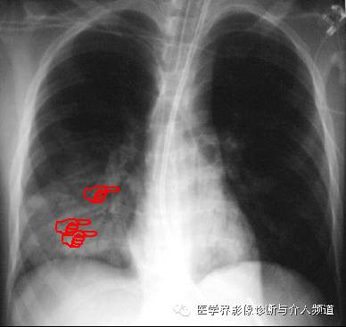 一张胸片走江湖之大叶性肺炎 一张胸片走江湖之大叶性肺炎