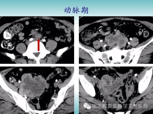 【病例】恶性纤维组织细胞瘤1例CT