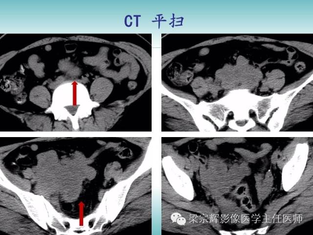 【病例】恶性纤维组织细胞瘤1例CT