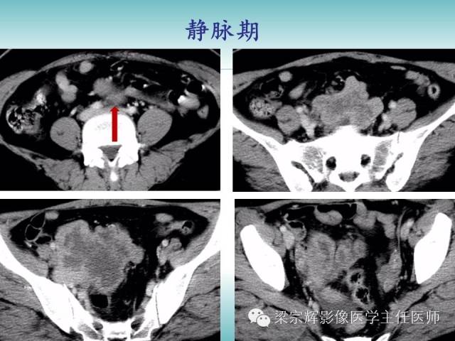 【病例】恶性纤维组织细胞瘤1例CT