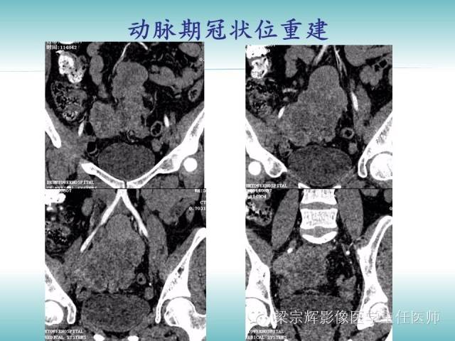 【病例】恶性纤维组织细胞瘤1例CT