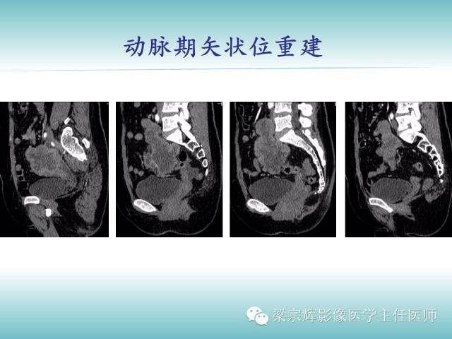 【病例】恶性纤维组织细胞瘤1例CT