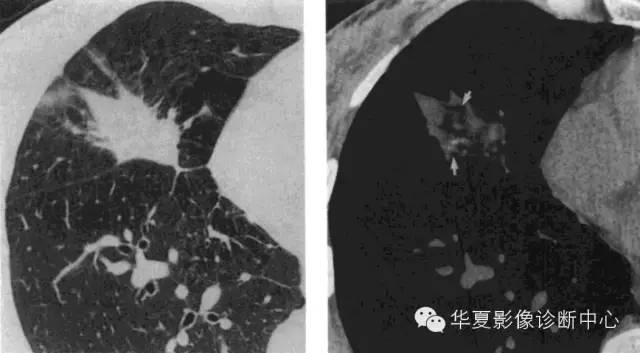 脂质性肺炎