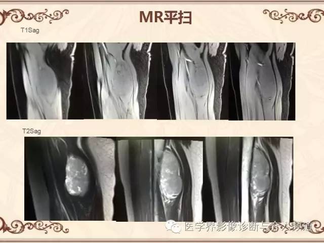 【病例】膝关节滑膜肉瘤1例MR影像表现