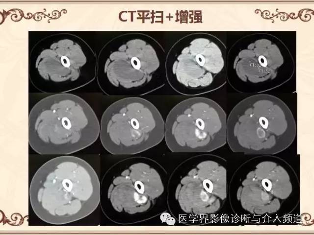 【病例】膝关节滑膜肉瘤1例MR影像表现